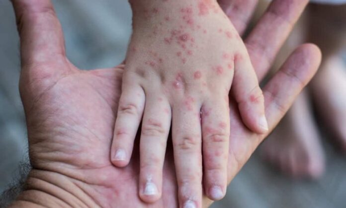 Dinkes Kalsel waspadai mpox dinkes waspadai Mpox