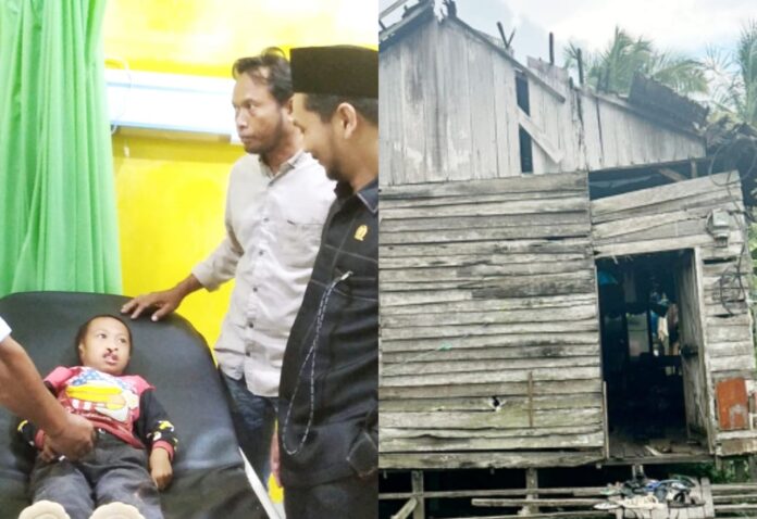penderita bibir sumbing dan tidak memiliki dua daun telinga Anak penderita bibir sumbing dan tidak memiliki dua daun telinga, Ahmad Hilmi warga RT06, Desa Tampang Awang saat dikungjungi Anggota DPRD Banjar Wahyu Akbar ramai diberbagai portal berita